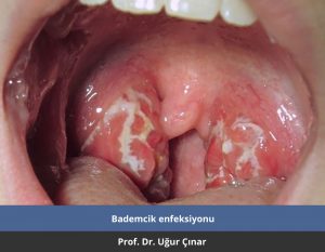 Bademcik enfeksiyonu - Prof. Dr. Uğur Çınar