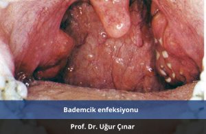 Bademcik enfeksiyonu - Prof. Dr. Uğur Çınar