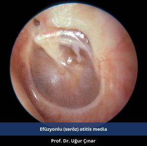 Efüzyonlu orta kulak enfeksiyonu - Prof. Dr. Uğur Çınar
