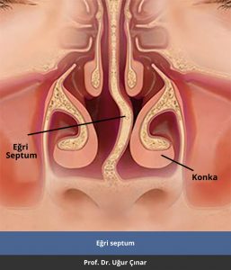 Eğri septum - Prof. Dr. Uğur Çınar