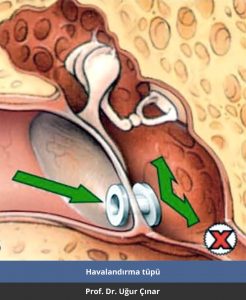 Havalandırma tüpü nedir? - Prof. Dr. Uğur Çınar