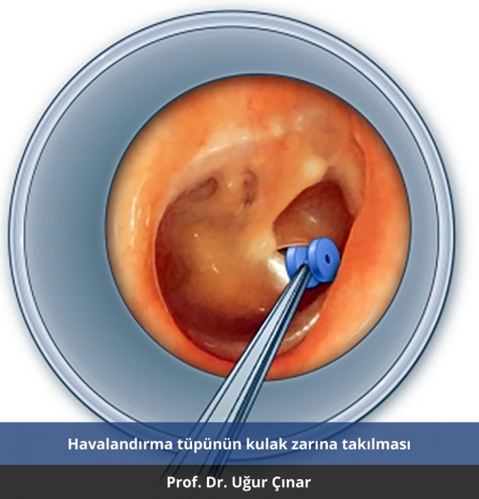 geniz eti kaç yaşında alınır