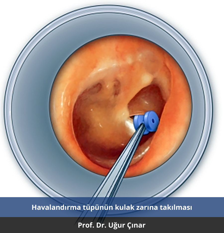 Kulak tüpü nasıl takılır? - Prof. Dr. Uğur Çınar