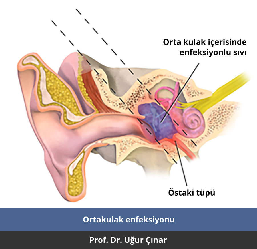Orta kulak enfeksiyonu nedir? - Prof. Dr. Uğur Çınar