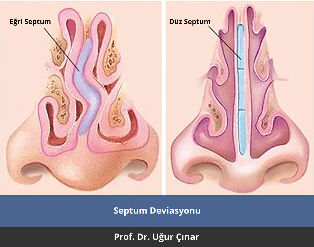 Septum Deviasyonu Tedavisi - Prof. Dr. Uğur Çınar