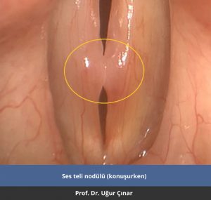 Ses teli nodülü - Prof. Dr. Uğur Çınar