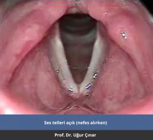 Ses telleri açık - Prof. Dr. Uğur Çınar